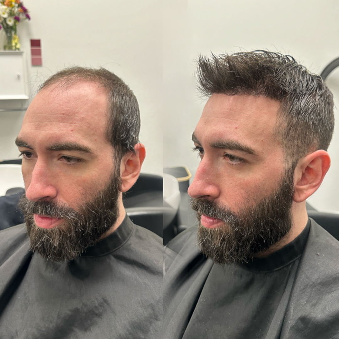 Before-and-after hair system result for a bearded client