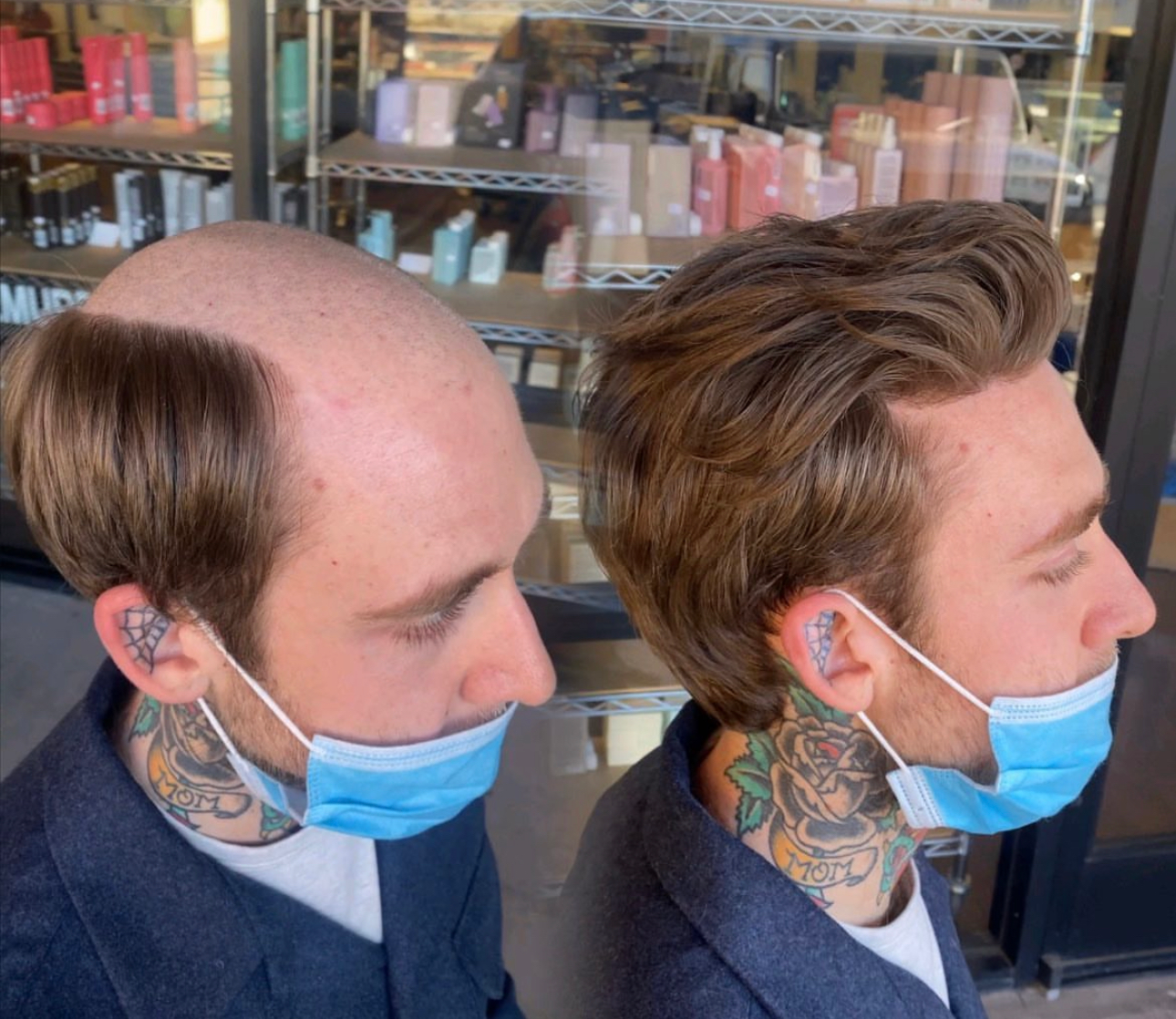 Men's hair system before-and-after result for a consultation