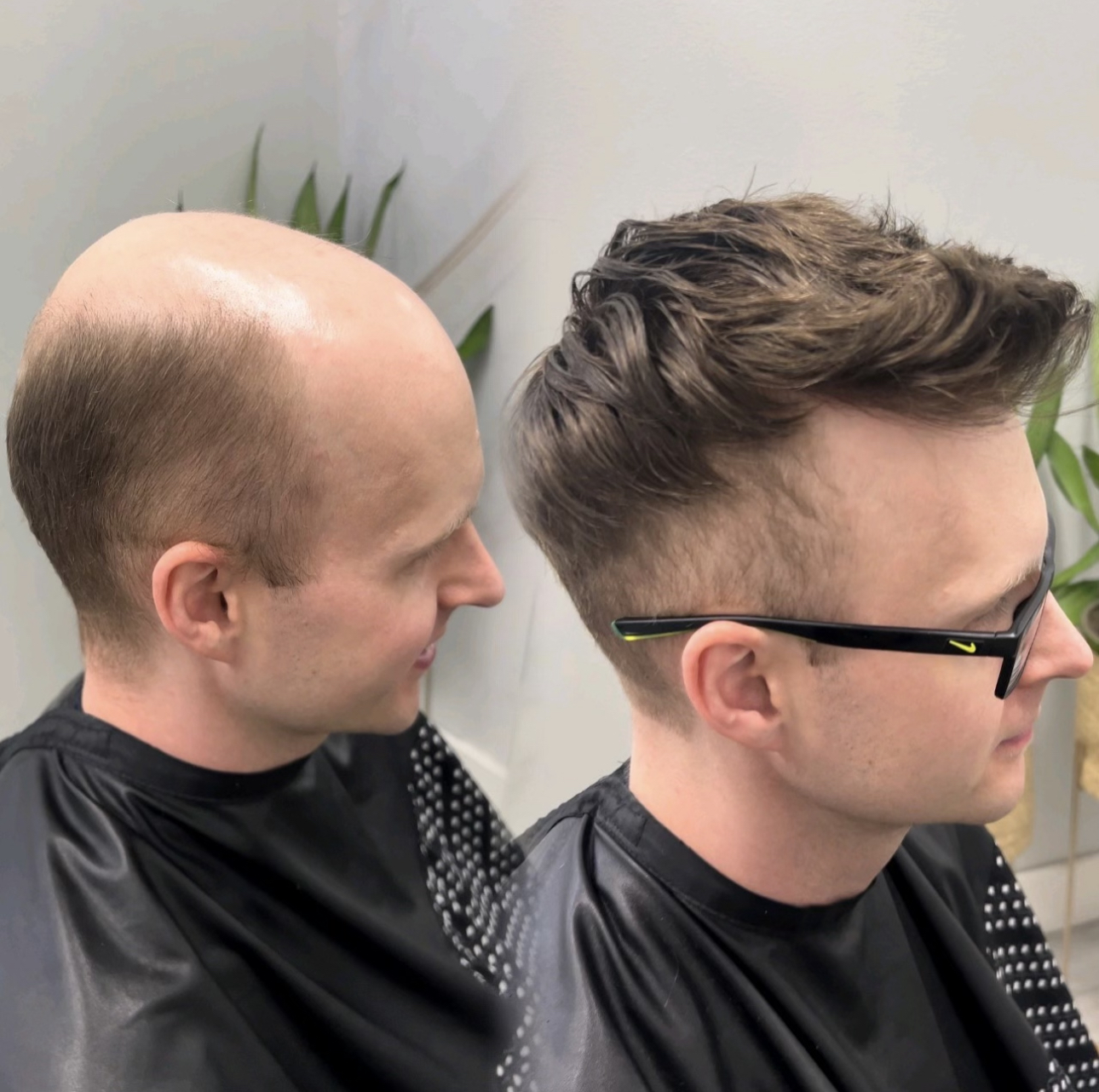Before-and-after custom hair system result